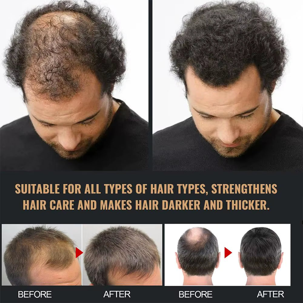 2PCS anti Baldness Shampoo Thickening Shampoo Root Activator Shampoo Nourish Hair Regrowth Shampoo for Thinning Hair & Hair Loss